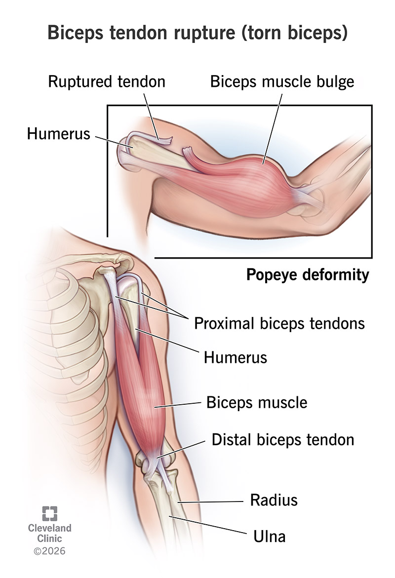 A ruptured proximal biceps tendon causing a bulging muscle that’s also known as a Popeye deformity