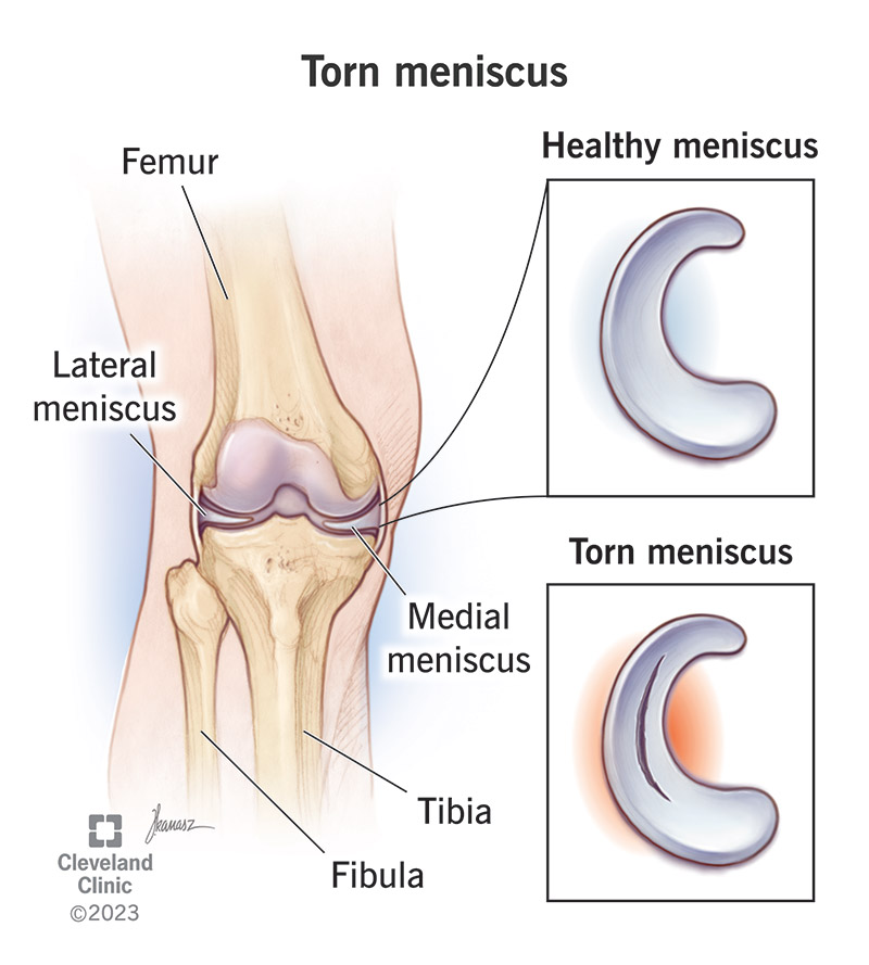 Comparing a healthy meniscus to a torn meniscus