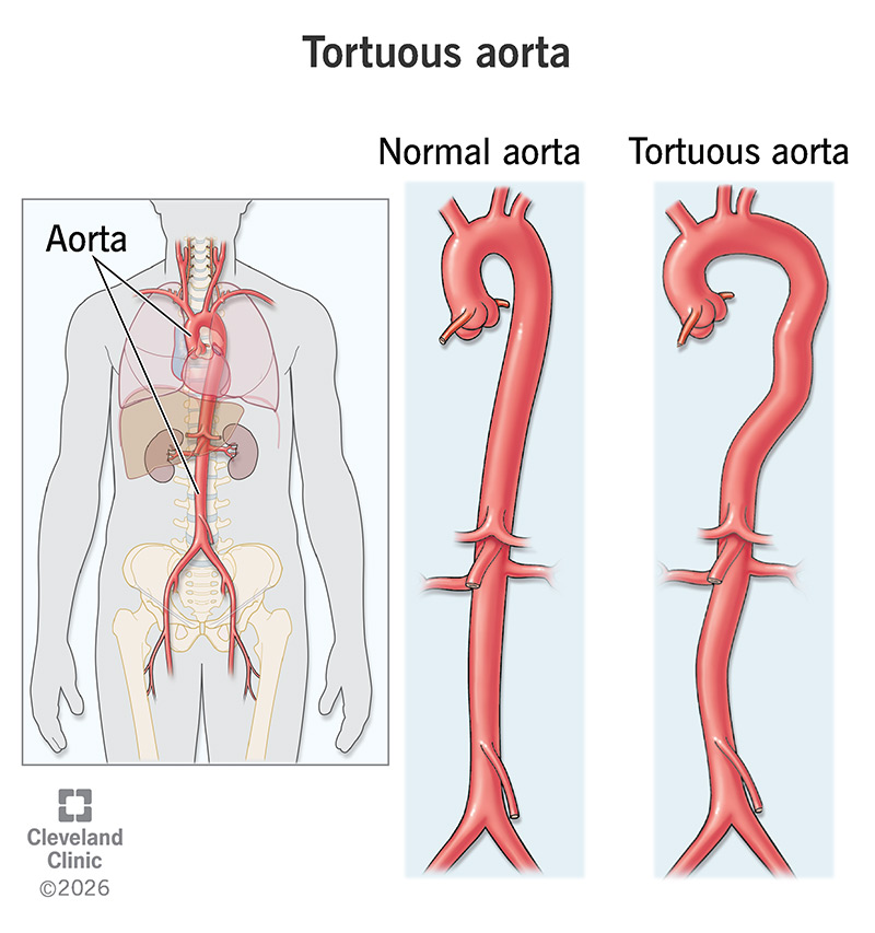 Illustrations comparing a normal aorta to a tortuous aorta