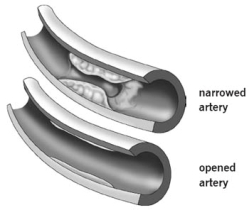 Enfermedad de la arteria coronaria