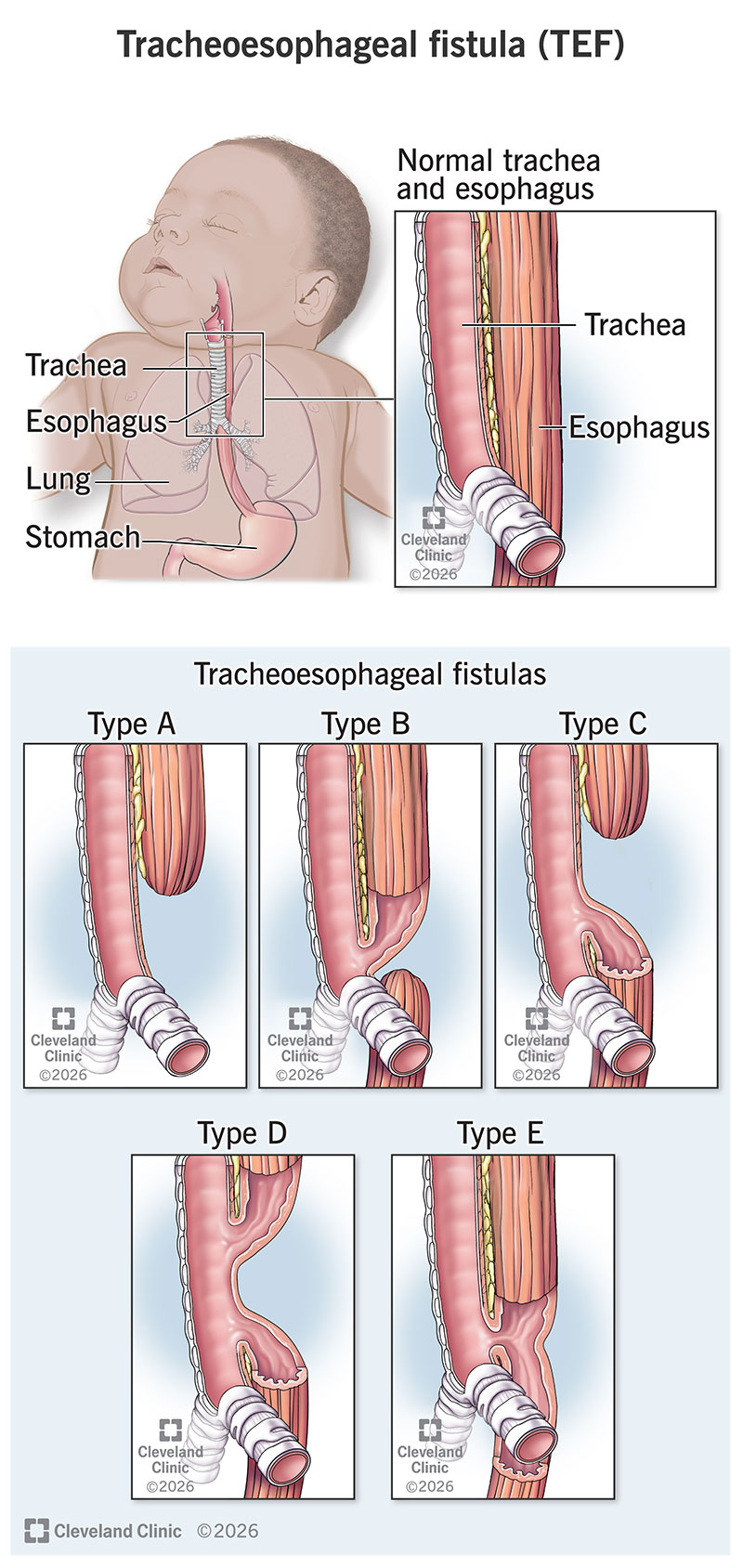 A normal trachea and esopahgus in a baby, and the five types of tracheoesophageal fistulas (TEFs)
