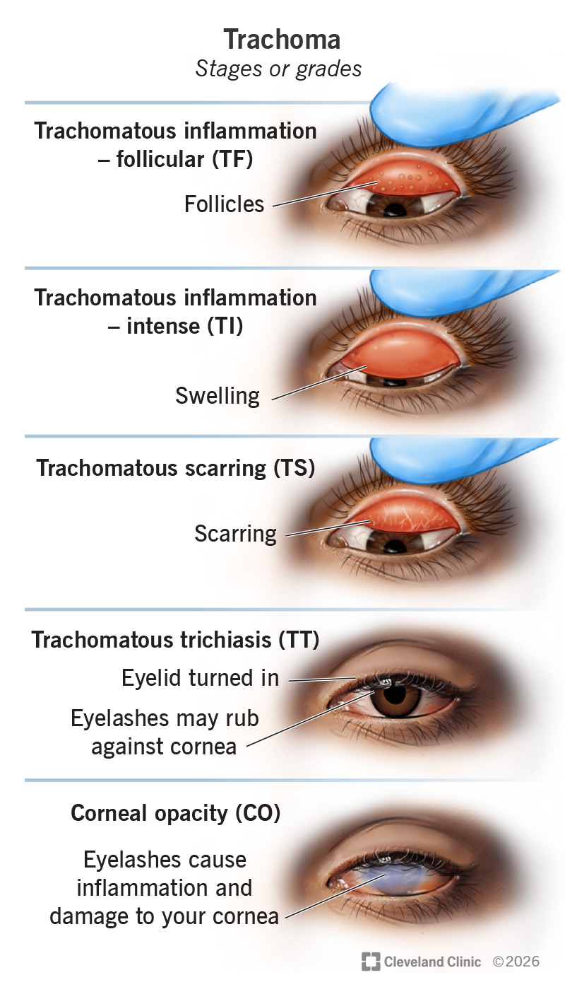 Stages/grades of trachoma, including inflammation – follicular, scarring, turned in eyelids and cornea damage
