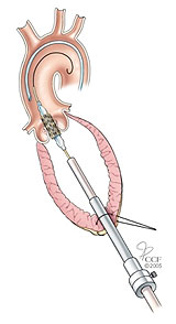 Transcatheter Aortic Valve Replacement (TAVR): TAVR Procedure ...