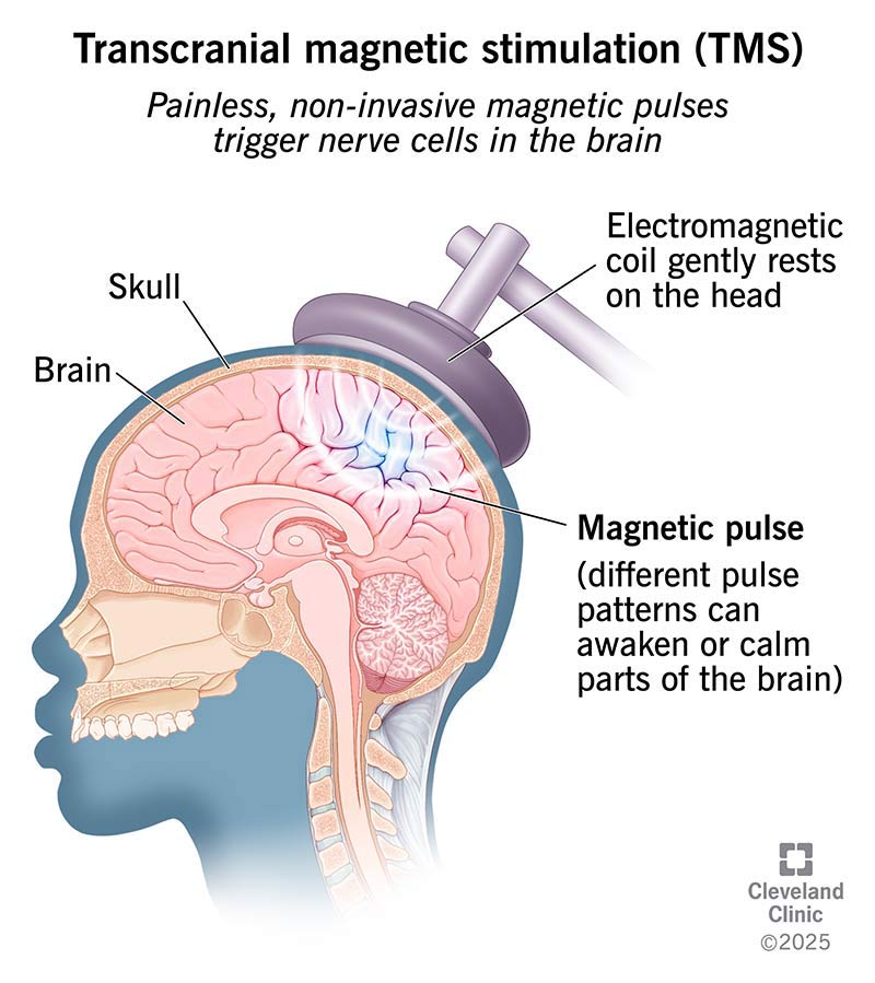 Electromagnetic coil on head delivers pulses to brain areas through the skull during transcranial magnetic stimulation