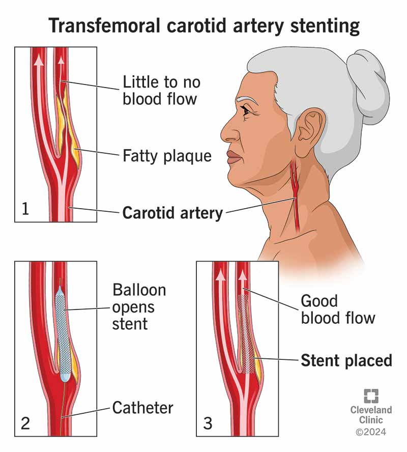 A transfemoral carotid artery stenting procedure places a stent to improve blood flow in your artery