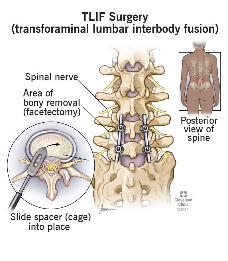 TLIF surgery, with spinal slide spacers in place