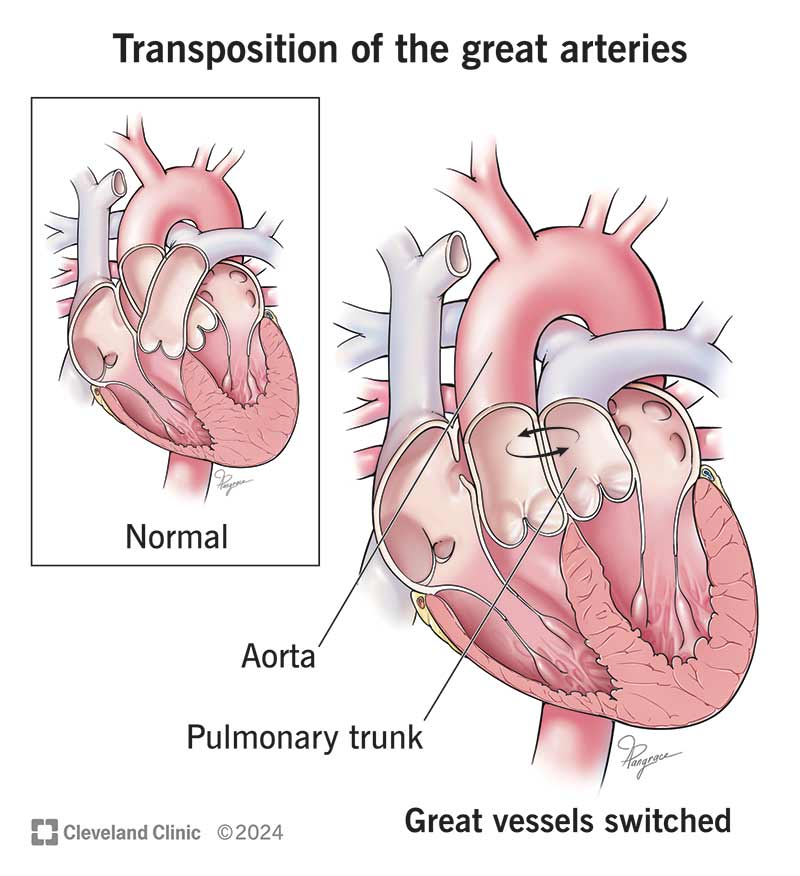 A heart with transposition of the great arteries has the aorta and pulmonary artery reversed