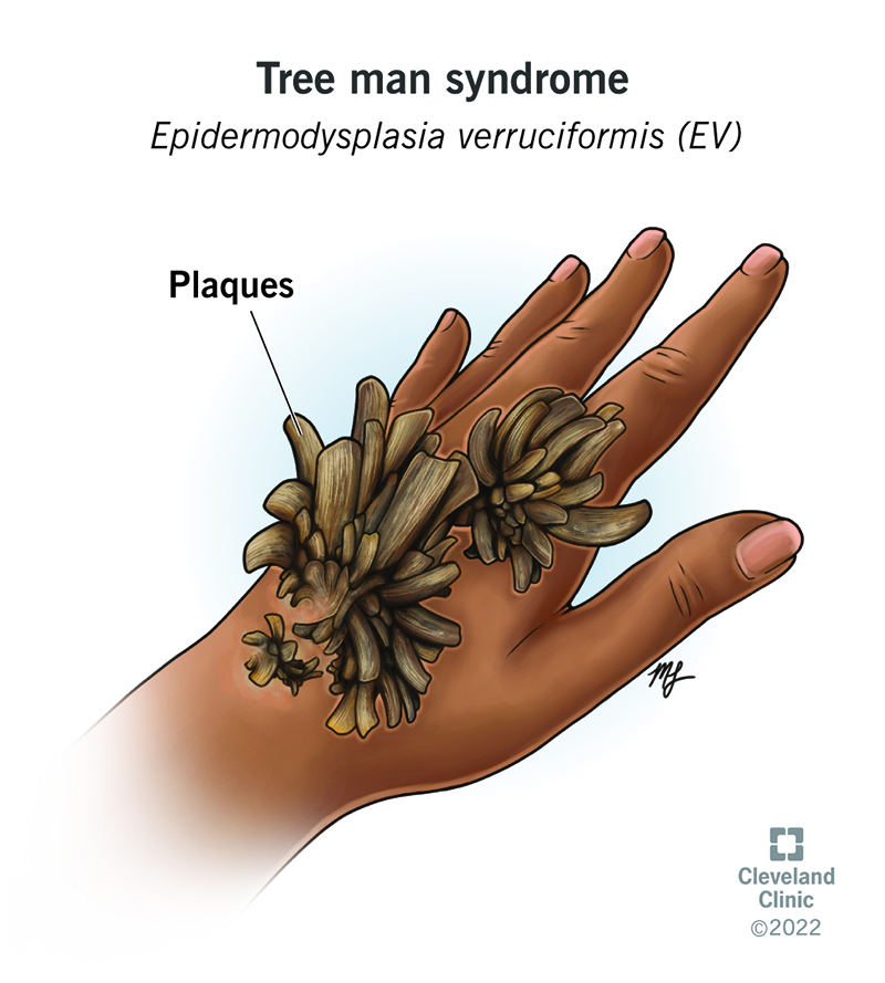 A person’s hand with tree person syndrome plaques that resemble tree bark