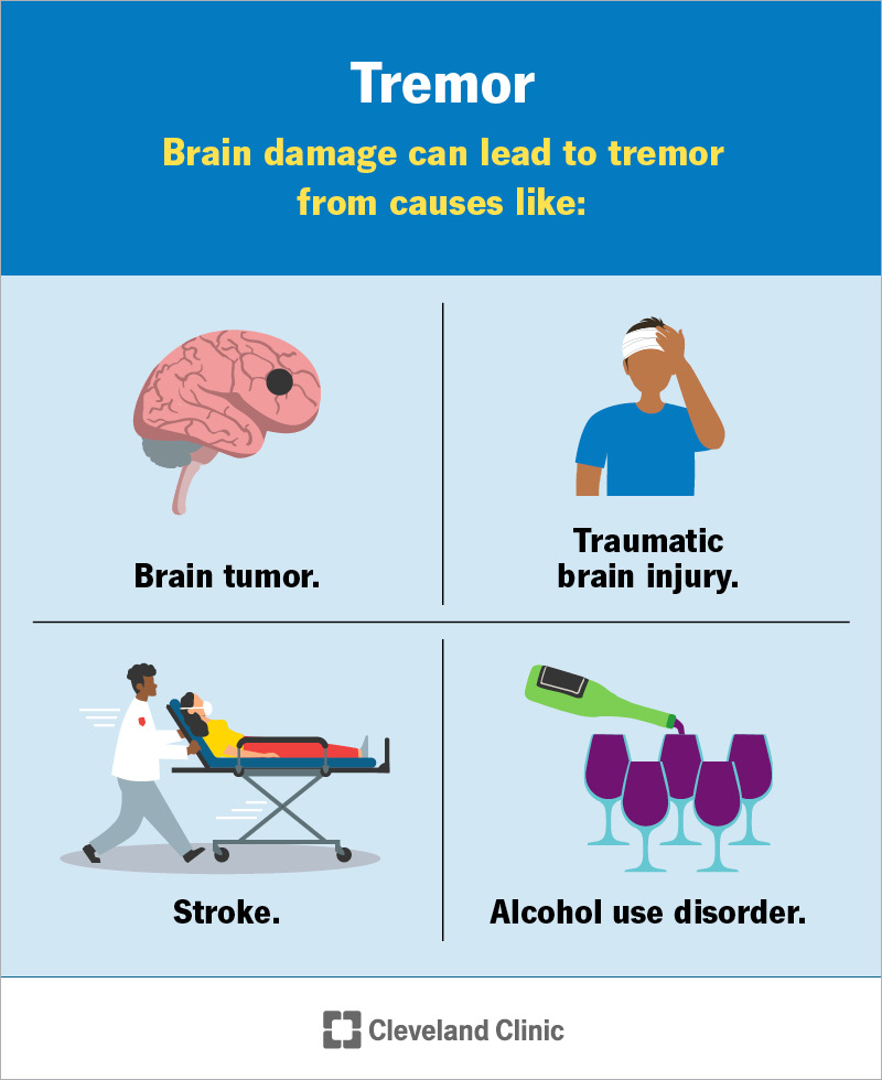 Brain damage can cause tremor from issues like stroke, brain tumor, alcohol use disorder and traumatic brain injury