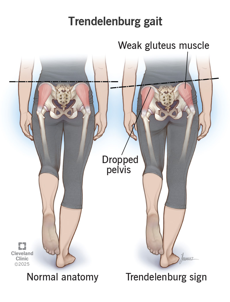 Trendelenburg gait causing pelvis to dip to one side while walking
