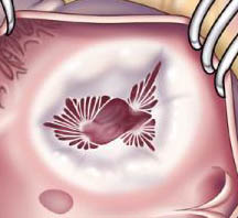 Tricuspid Regurgitation