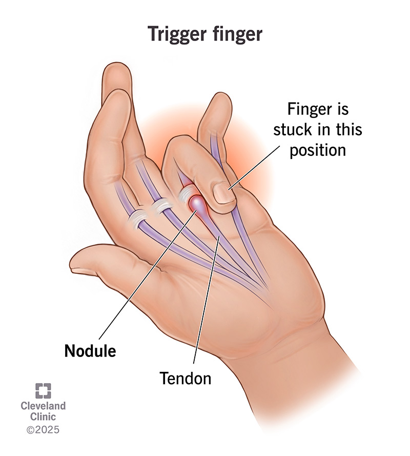 Swelling in or around tendons in your hand causes trigger finger