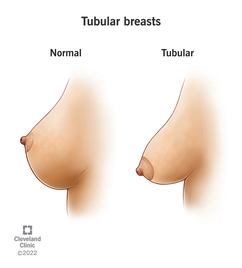 A profile comparison of normal breast growth and tubular breasts.