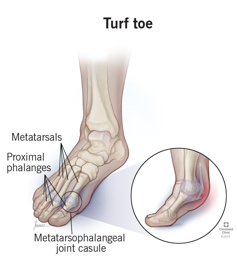 Turf Toe What It Is Causes Symptoms Treatment Turf Toe What It Is Causes Symptoms Treatment