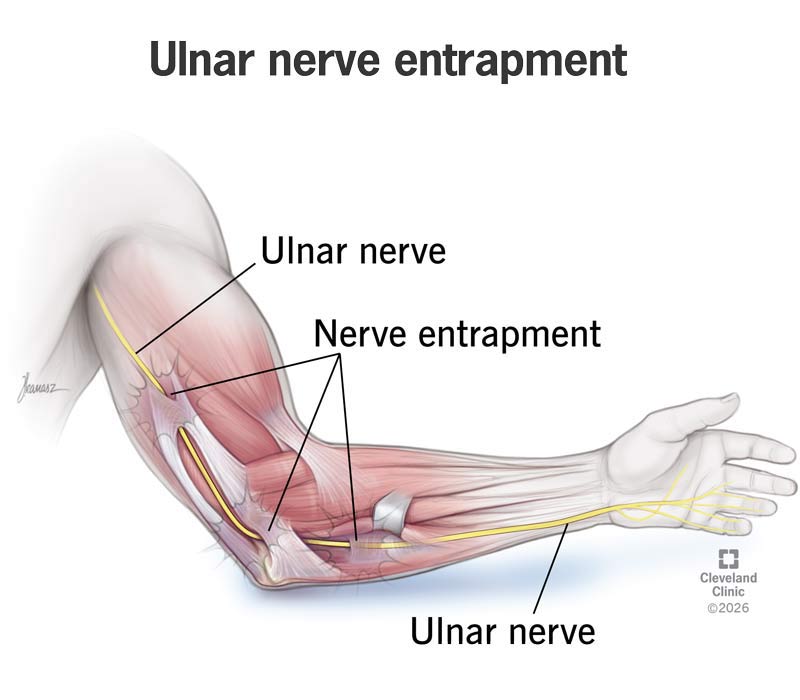 Ulnar nerve entrapment in the upper arm, elbow and forearm