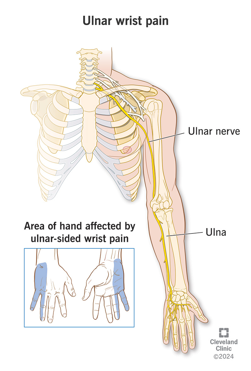 Anatomy of ulnar wrist pain, with ulnar nerve running from the shoulder, past the elbow on the same side as the pinkie finger