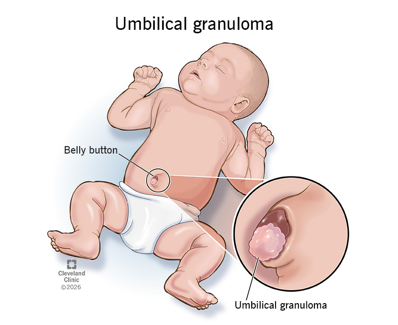 Newborn with an umbilical granuloma in their belly button