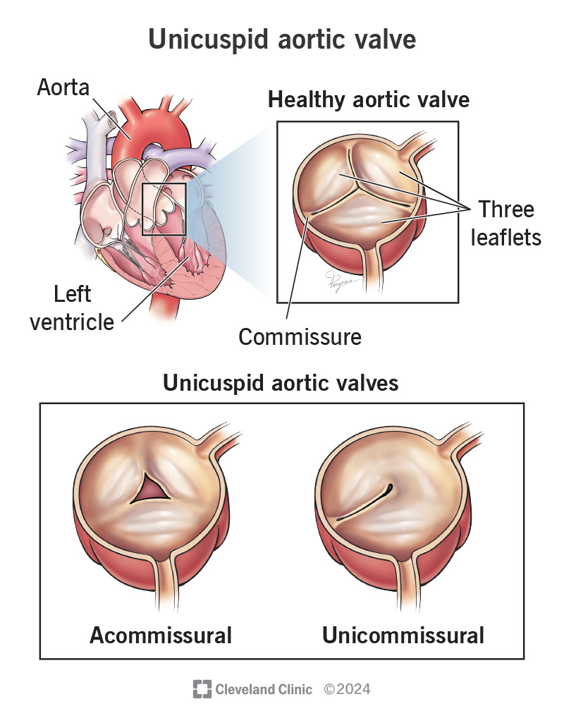 A typical aortic valve compared to the two types of unicuspid aortic valve with one leaflet.