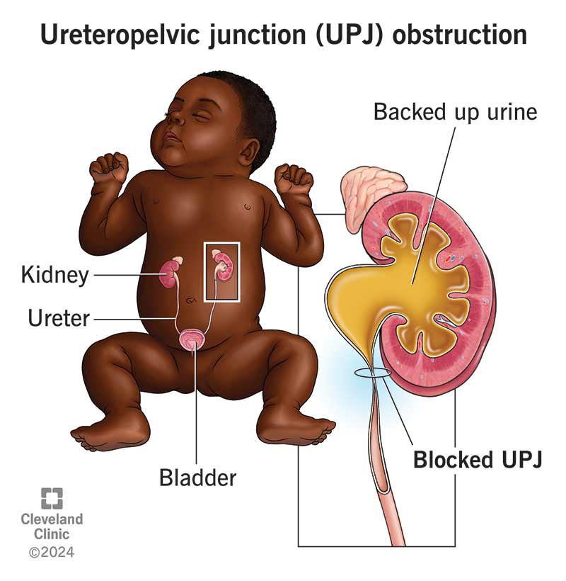 Ureteropelvic junction (UPJ) obstruction is usually present at birth and affects pee flow near the renal pelvis in a kidney