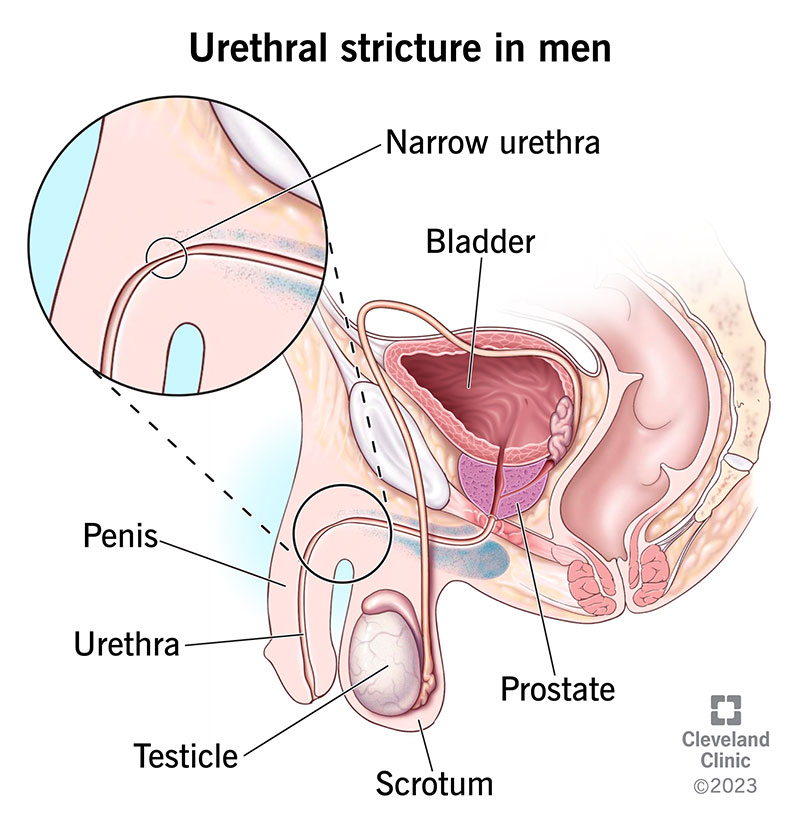 A urethral stricture is a narrow passage in your urethra. The urethra runs from the bladder to the outside of your body.