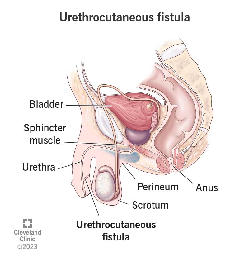 A urethrocutaneous fistula can cause pee to leak from the underside of your penis