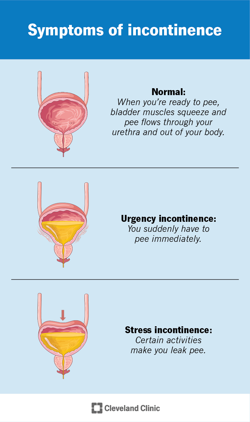 Incontinence affects how you pee. Urge incontinence causes you to need to use the restroom immediately