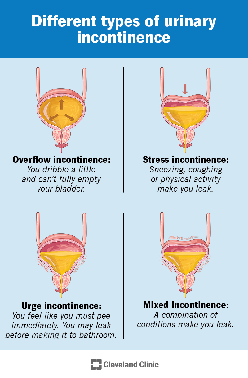 Urinary incontinence affects your bladder. You may only pee a little, leak after certain activities or have to pee suddenly