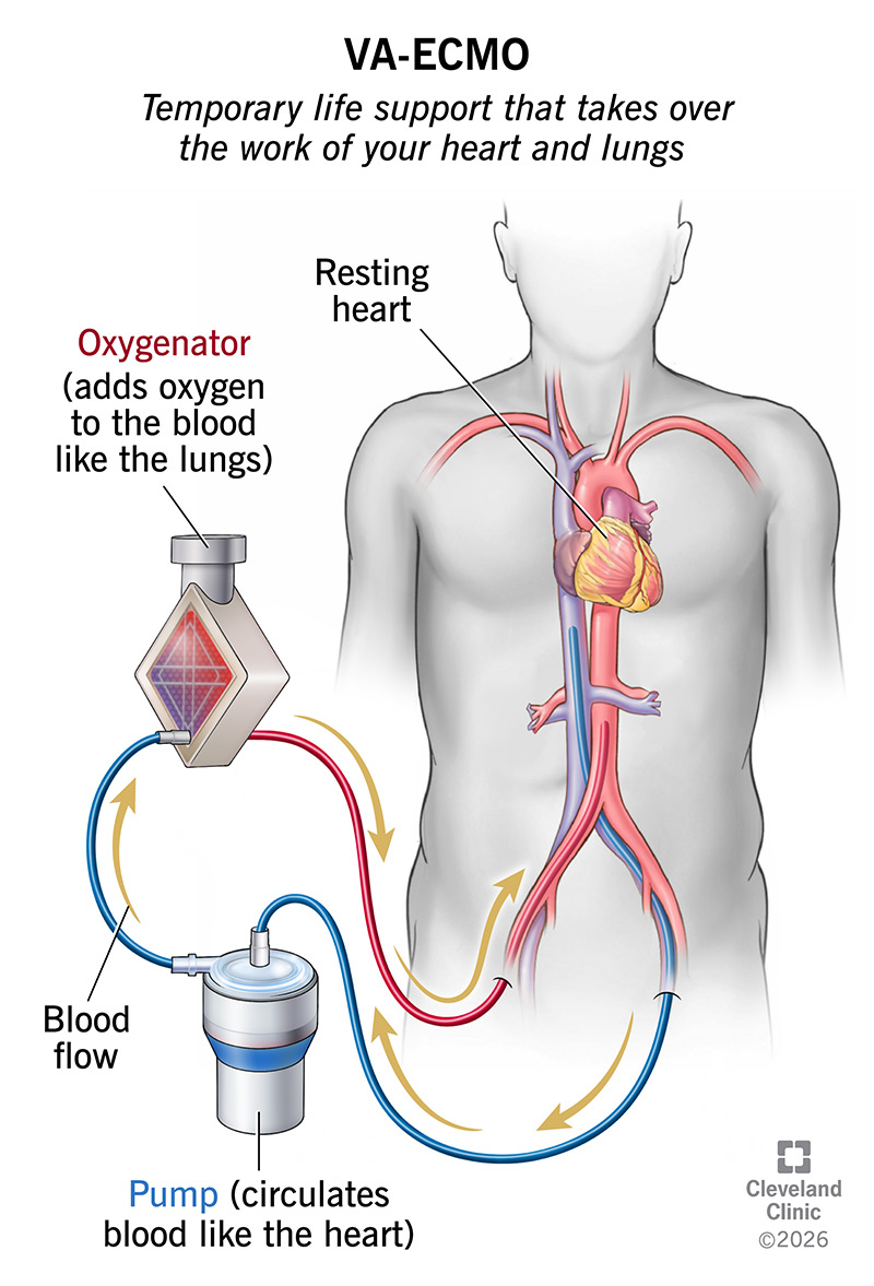 Antomy of VA-ECMO oxygenator, adding oxygen to blood while a pump circulates blood through a body