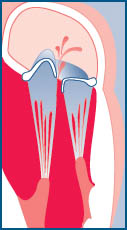 Mitral valve prolapse