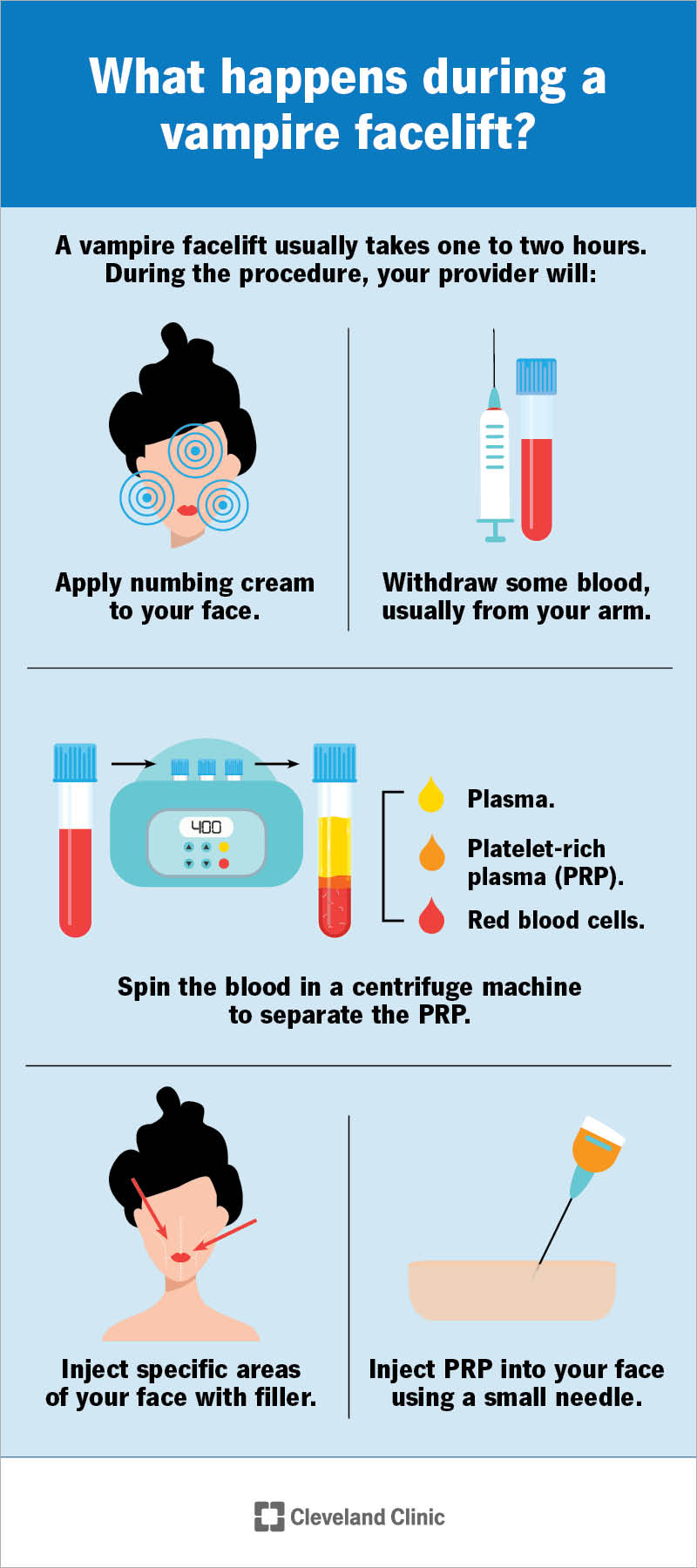 The steps of a non-surgical vampire facelift (PRP facelift) procedure.