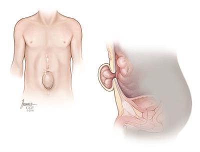 Ventral Hernia: Causes, Symptoms, Diagnosis & Treatment