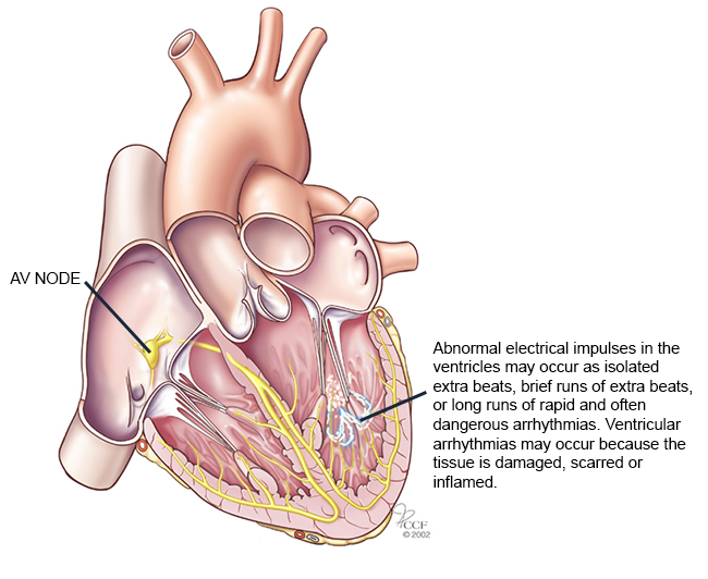 arritmia ventricular