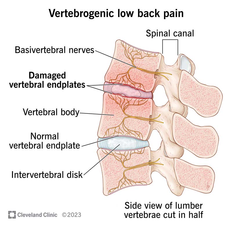 Vertebrogenic low back pain occurs when the endplates between your vertebral bones and cushioning disks become damaged.