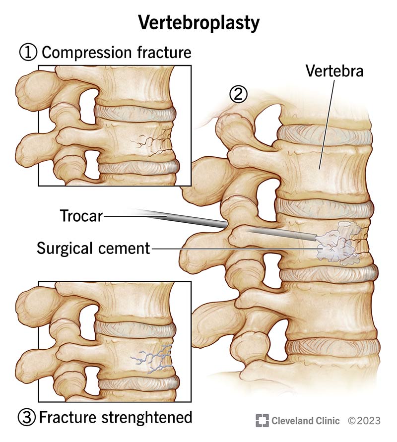 A compression fracture in the spine treated with surgical cement during a vertebroplasty.