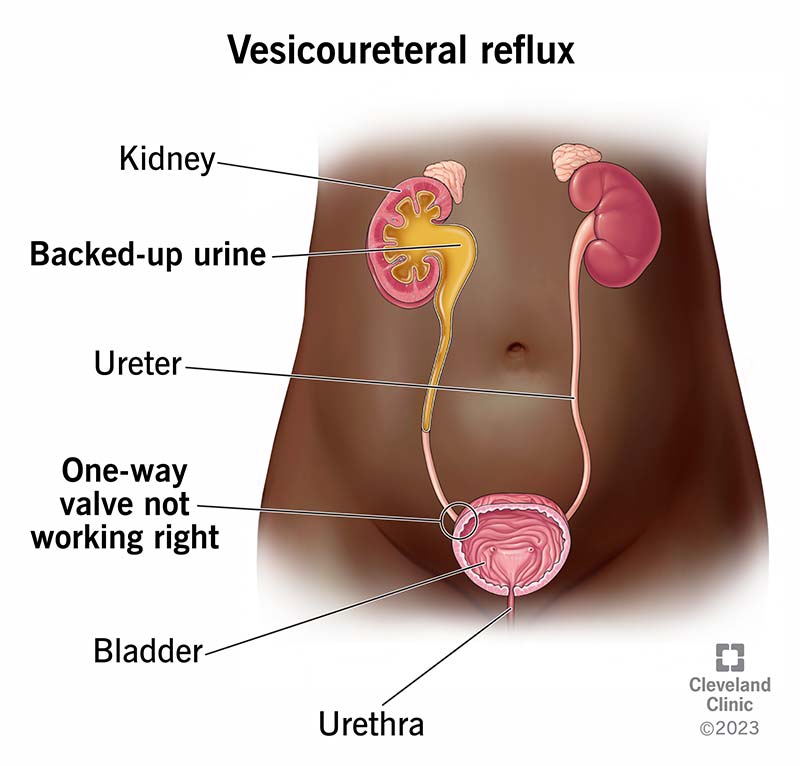 Urinary system showing pee backing up in one ureter and kidney next to a ureter and kidney that are normal.