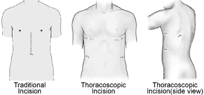 Thoracoscopy and Video-Assisted Thoracic Surgery (VATS) | Cleveland Clinic