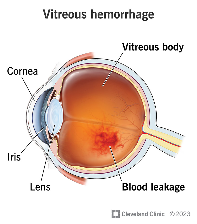 A vitreous hemorrhage is when damaged blood vessels leak blood into the vitreous body, a gel-filled area in your eye