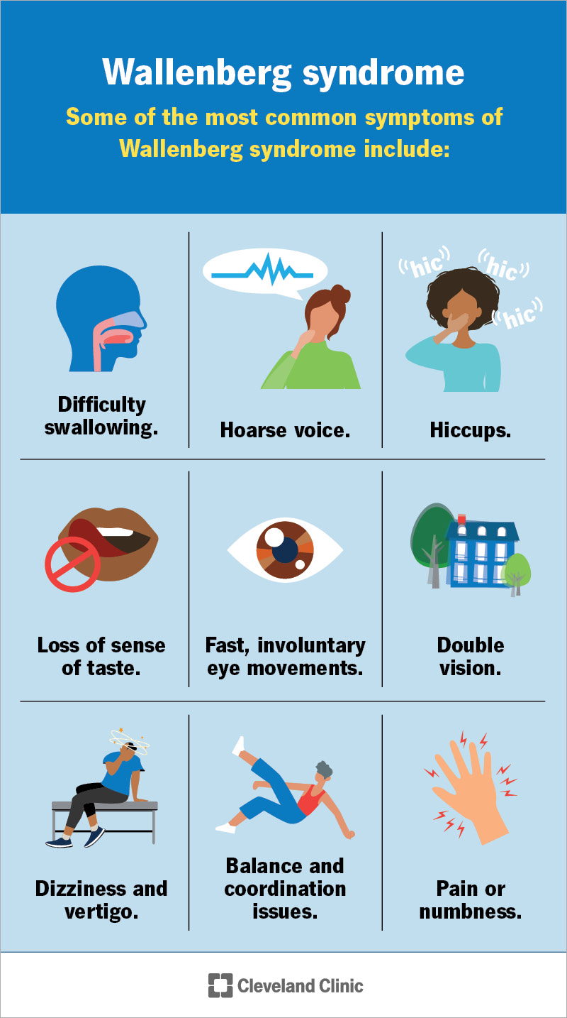 Common symptoms of Wallenberg syndrome after a brainstem stroke are hiccups, double vision and vertigo or dizziness