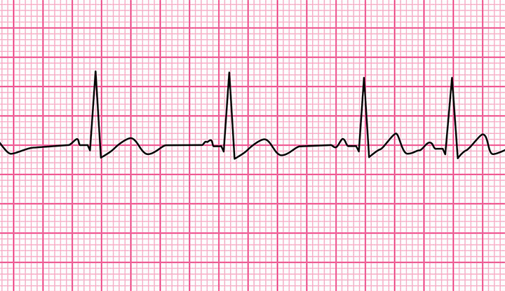 With a wandering atrial pacemaker, an EKG shows different P waves (the short ones just before the highest peaks)
