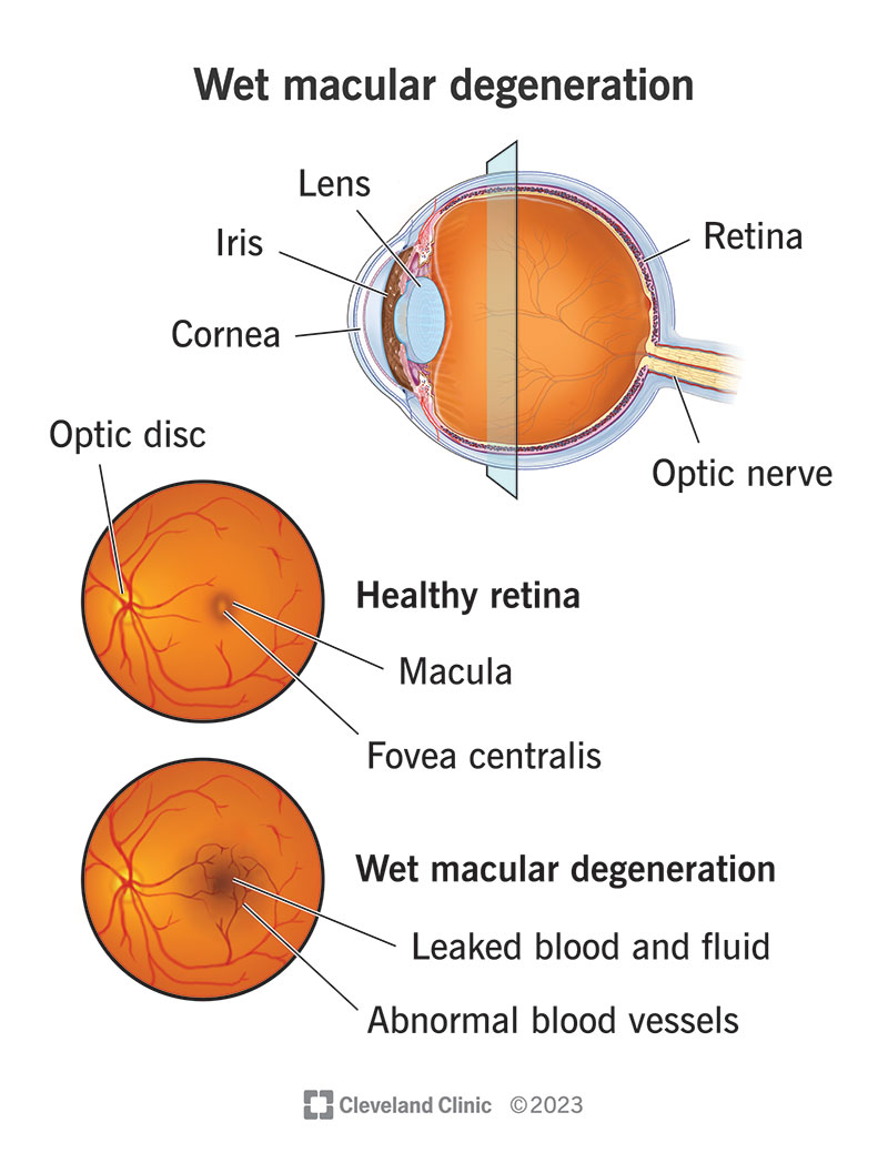 Wet macular degeneration happens when fluid seeps out and forces retinal layers apart, which leads to vision loss.