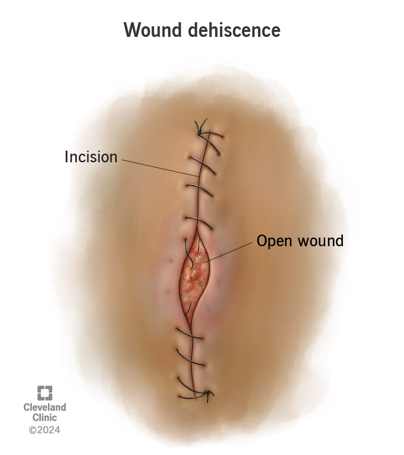 Broken stitches or sutures may cause a surgical incision (cut) to open or pull apart and expose internal tissues or organs.