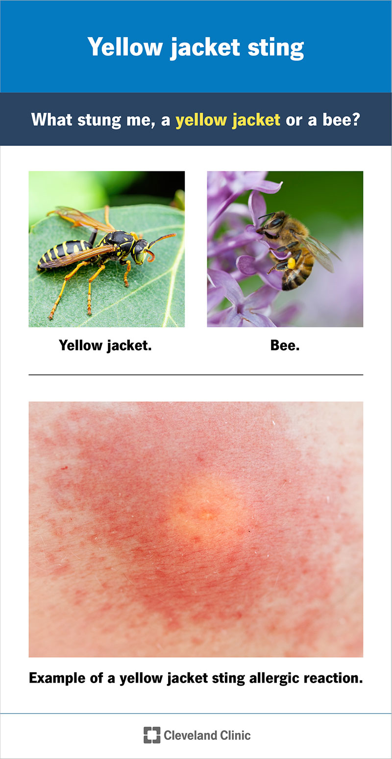 Yellow jacket and bee, with yellow jacket sting that is red and swollen