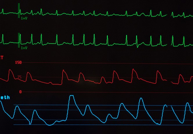 Atrial Fibrillation Assessment