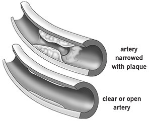 An illustration of a clear artery and an artery narrowed with plaque.