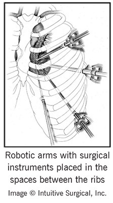 Robotic arms with surgical instruments placed in the spaces between the ribs.