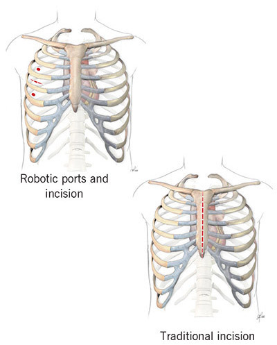 Robotic ports and incisions on the chest.