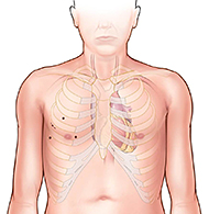 chirurgie cardiaque assistée par robot