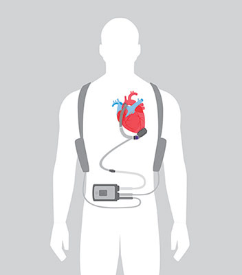 Left Ventricular Assist Device (LVAD)