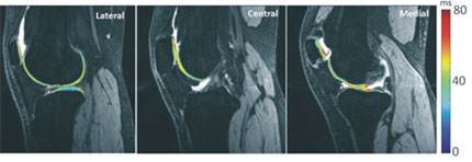 T1ρ relaxation times mapped to patellofemoral and tibiofemoral cartilage after a patellar dislocation.