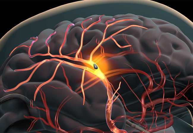 Stroke Assessment 